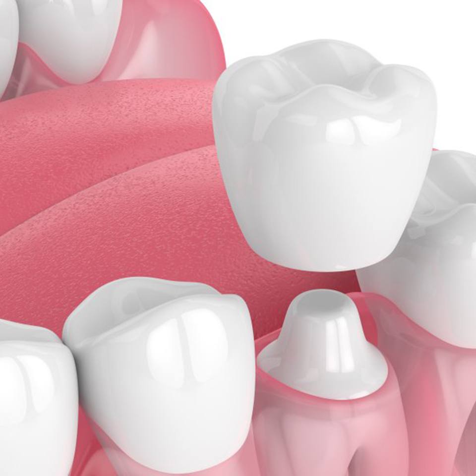 WHAT IS A DENTAL CROWN: 