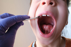 Dentist examining child’s mouth; signs of tongue-tie